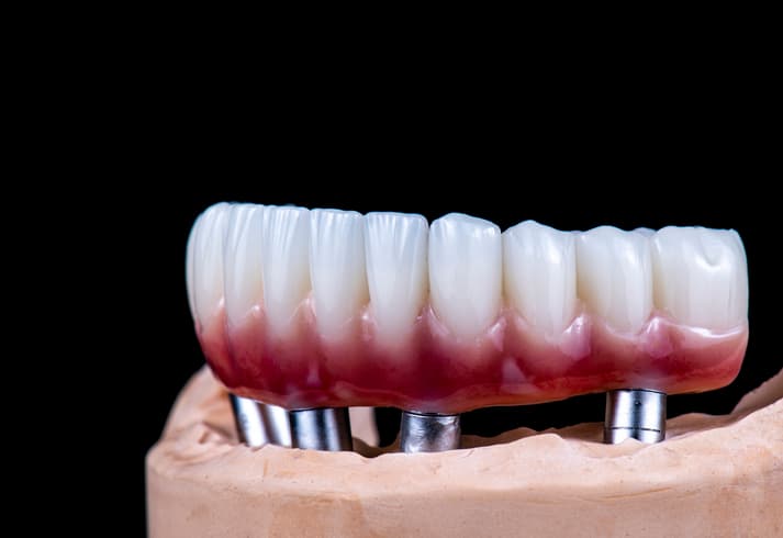 Implantatforankret protese som klikkes fast på implantater i underkjeven