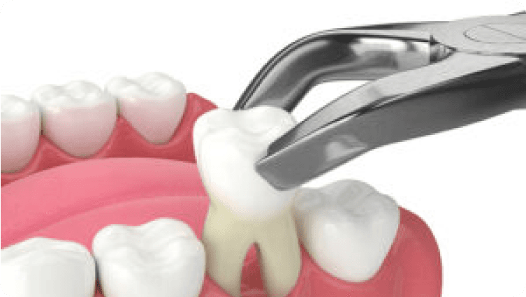 Når og hvordan fjernes en tann? Trygg og skånsom tannuttrekking.